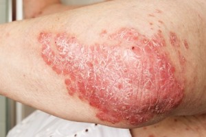 Detail of Psoriasis, psoriatic skin disease